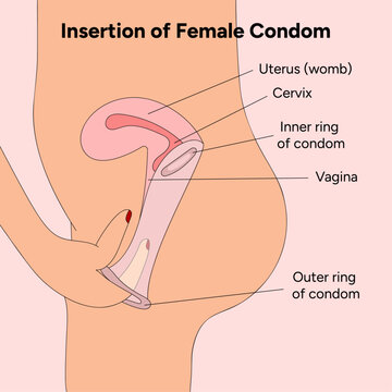 VELVET FEMALE CONDOM (FEMIDOM)